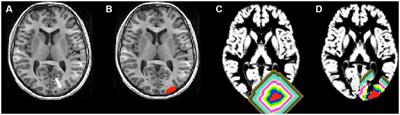 Functional profile of perilesional gray matter in focal cortical dysplasia: an fMRI study